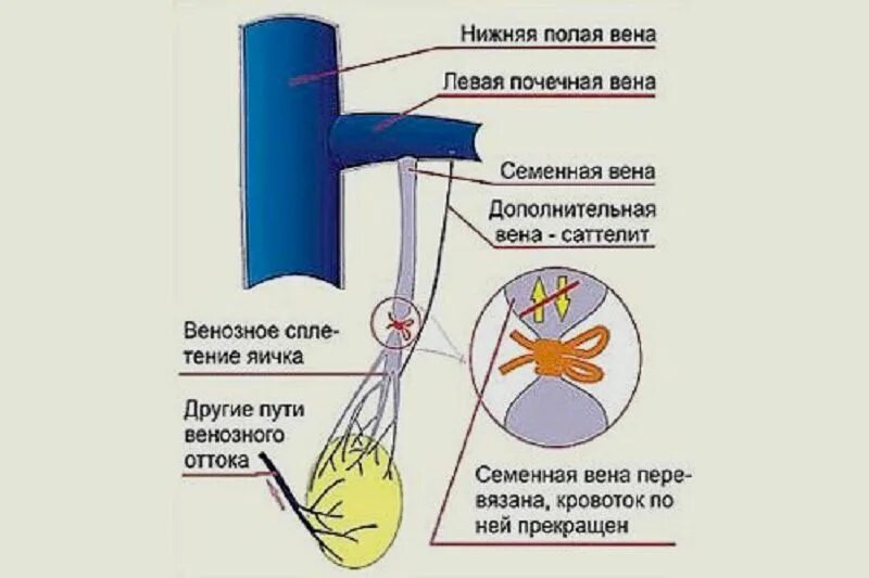 Расширение семенной вены. Операция по Иваниссевичу. Операция по Иваниссевичу при варикоцеле. Операция паломо при варикоцеле. Операция ванисевича паломо.