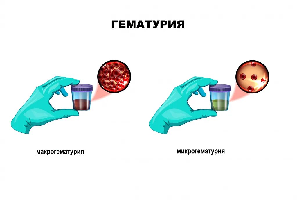 Моча каплями у мужчин. Гематурия. Гематурия в моче. Гематурия и микрогематурия. Тотальная гематурия.