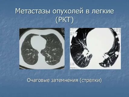 Объемное образование легкого