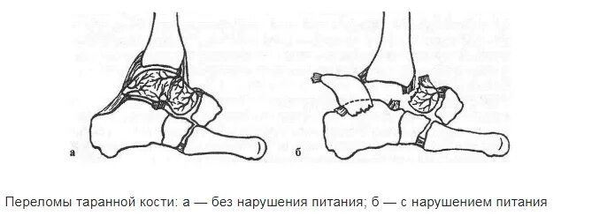 Таранная кость перелом. Перелом шейки таранной кости. Таранная кость голеностопа перелом. Перелом вывих таранной кости.