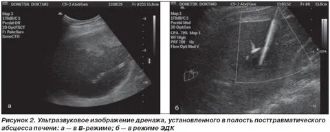 Инородные тела печени
