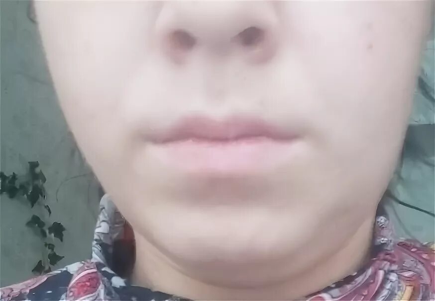 Опухает щека после удаления