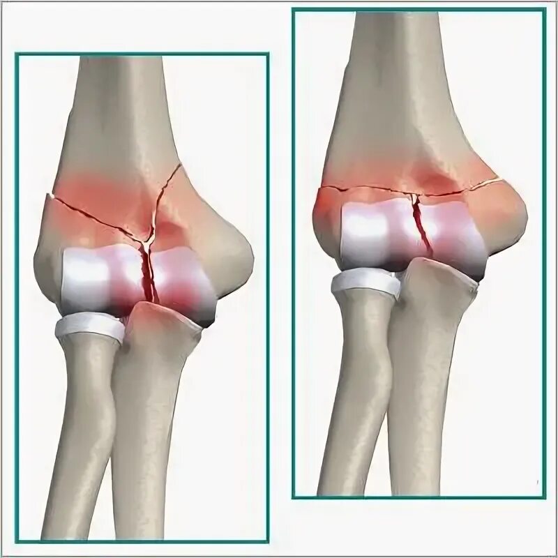 Перелом мыщелка локтевого сустава. Мыщелковый перелом локтевого сустава. Чрезмыщелковый перелом плеча. Перелом плечевой кости в локтевом суставе.