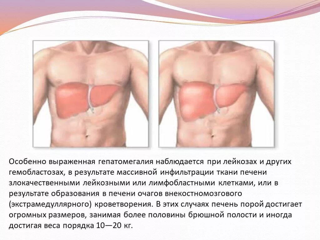 Гепатомегалия симптомы и лечение. Гепатомегалия. Увеличение размеров печени.