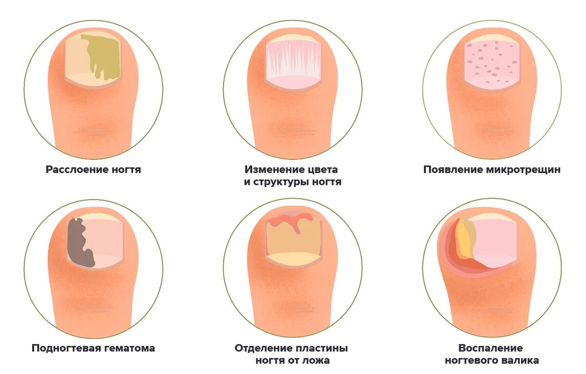 Сон Клопы под ногтем ноги. Толкование сна Клопы под ногтем ноги бесплатно онлайн