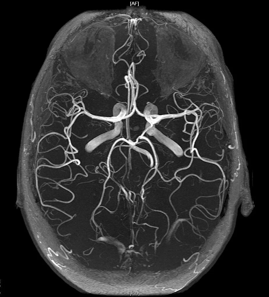 Мрт ангиография сосудов головного. МР-ангиография сосудов головного мозга анатомия. Виллизиев круг ангиография. Мрт головного мозга с ангиографией.