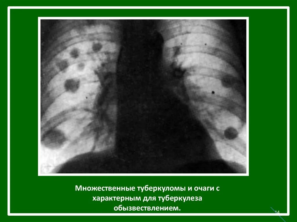 Внутренний туберкулез