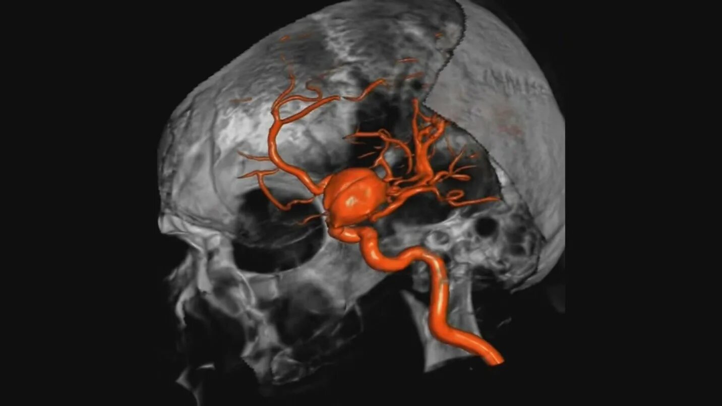 Задняя соединительная артерия мозга. Аневризме головного мозга. Микотическая аневризма. Мешотчатая аневризма вены.