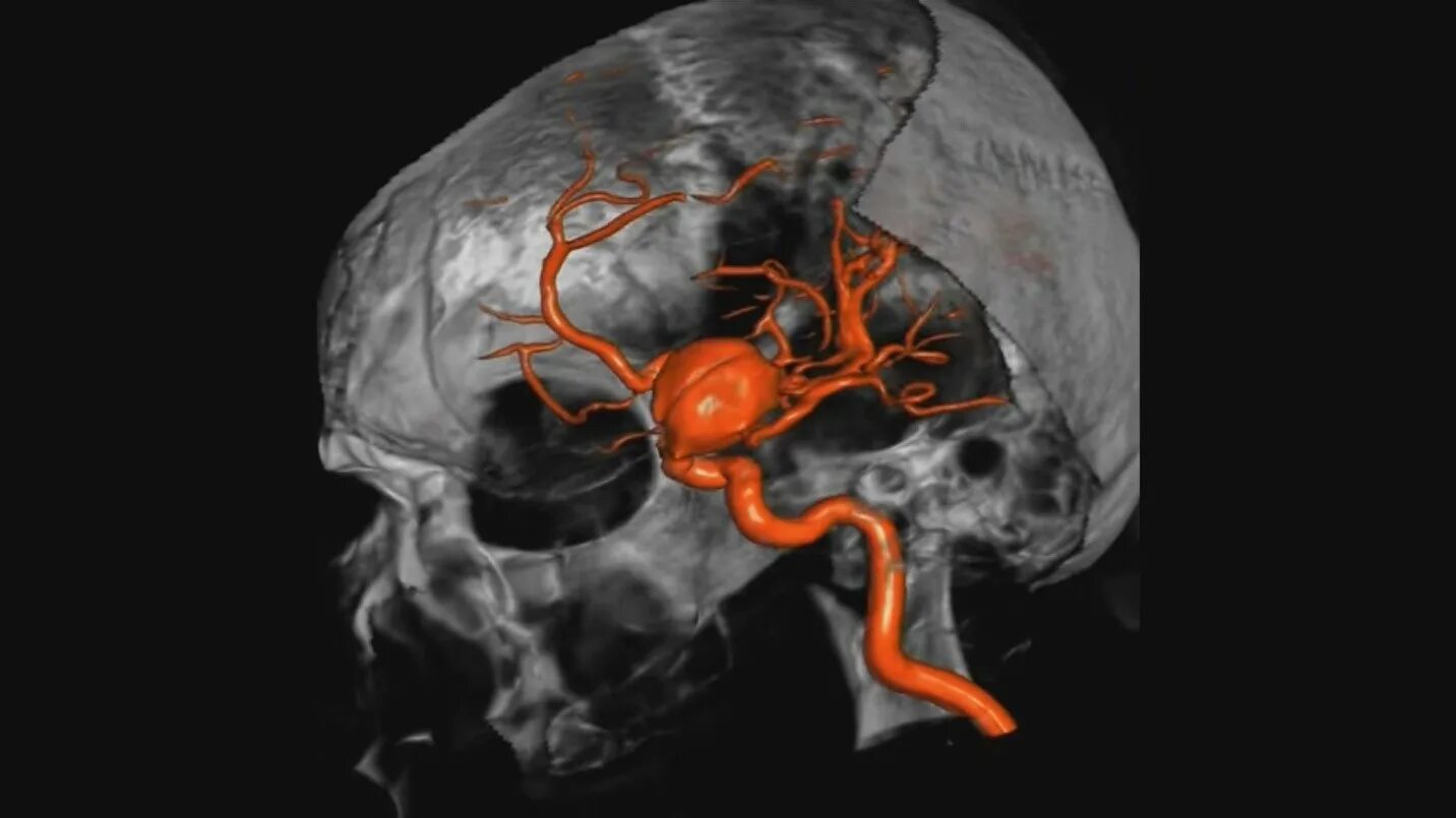 Форум аневризма мозга. Аневризме головного мозга. Микотическая аневризма. Мешотчатая аневризма вены.