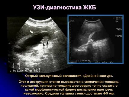 Камни в печени узи
