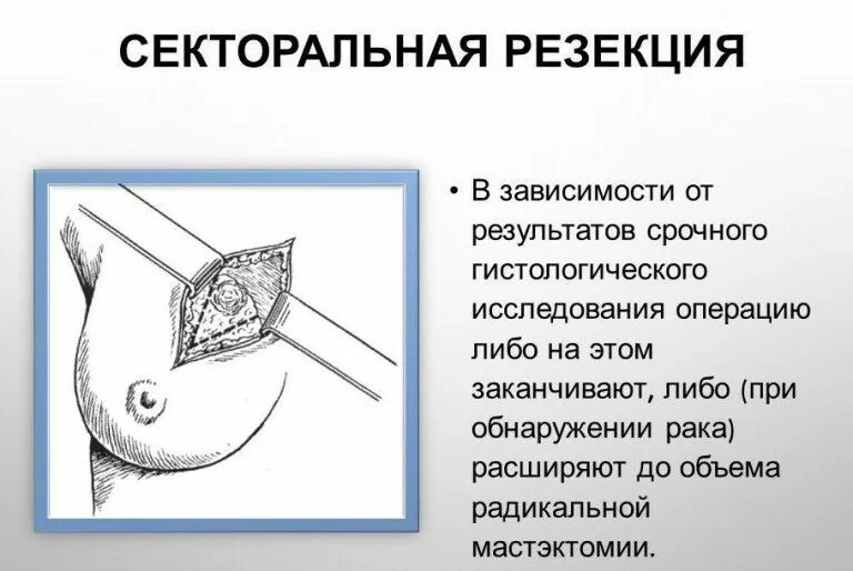 Делают какую операцию молочных желез. Секторальная резекция фиброаденомы. операция секторальная резекция молочной железы. секторальная резекция молочной железы фиброаденома. эксцизия опухоли молочной железы.