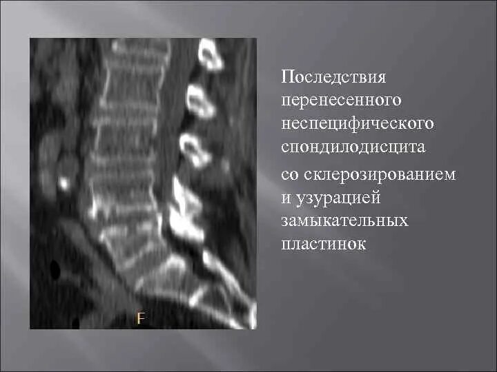 Грыжа Шморля замыкательная пластинка. Замыкательные пластинки тел позвонков. Узурация замыкательных пластинок. Узурация замыкательных пластинок тел позвонков.