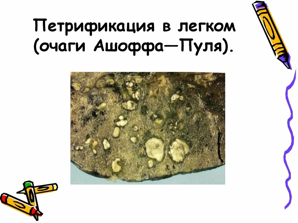 Очаг симон. Очаг ашоффа пуля микропрепарат.