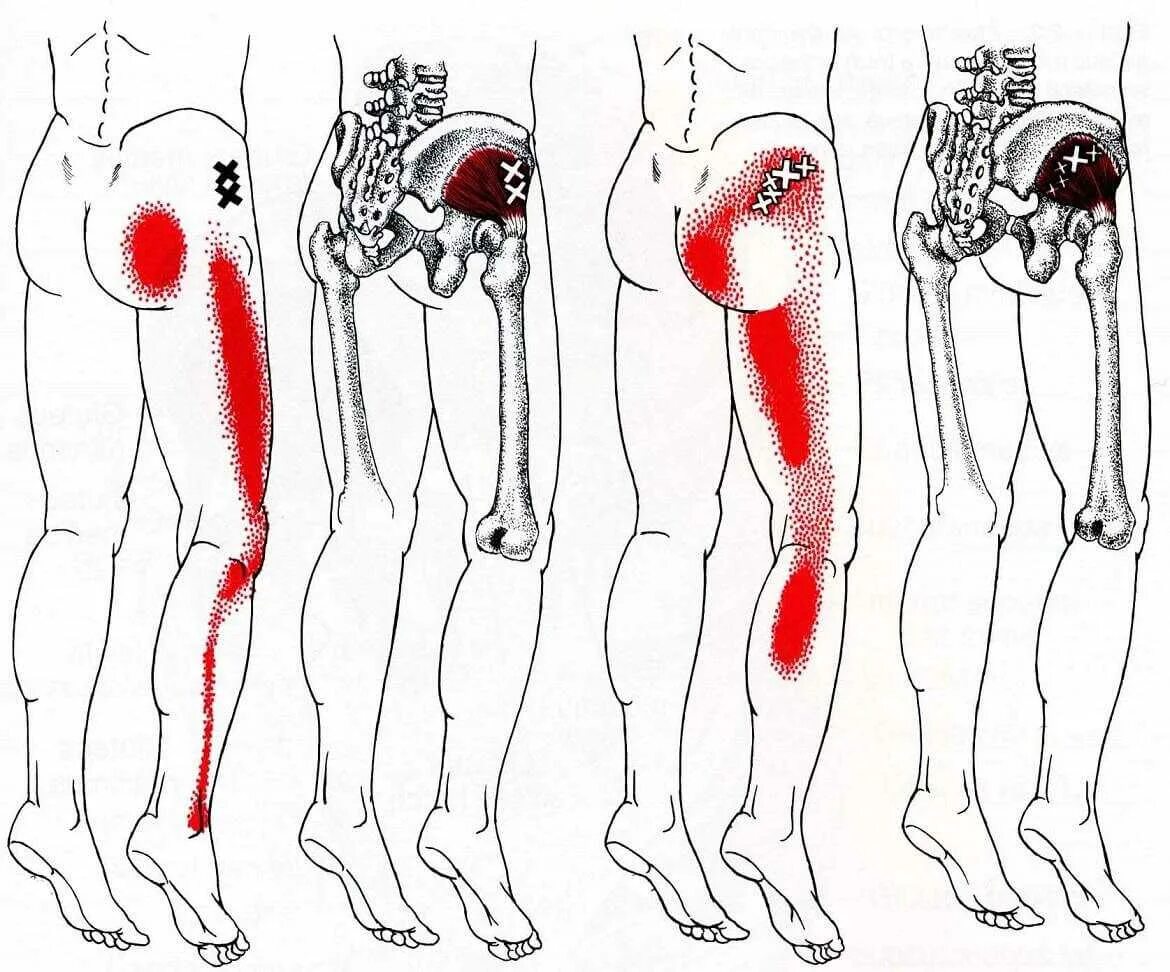 Болят ноги тянут ноют. Триггерные точки в мышцах тазобедренного сустава. Триггерные точки грушевидной мышцы. Синдром грушевидной мышцы триггерные точки. Триггерные точки ягодичной мышцы.