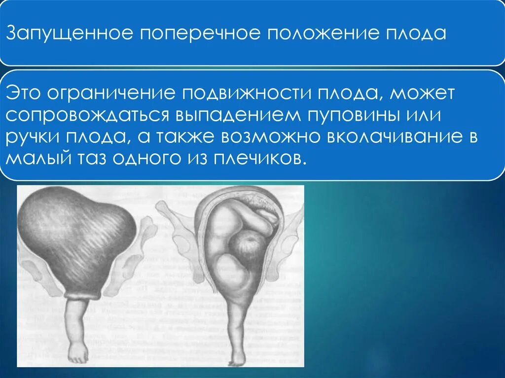 Позиция плода при поперечном положении. Запущенное поперечное положение плода. Поперечное положение плода позиция. Поперечное положение плода тактика. Поперечное и косое положение плода.