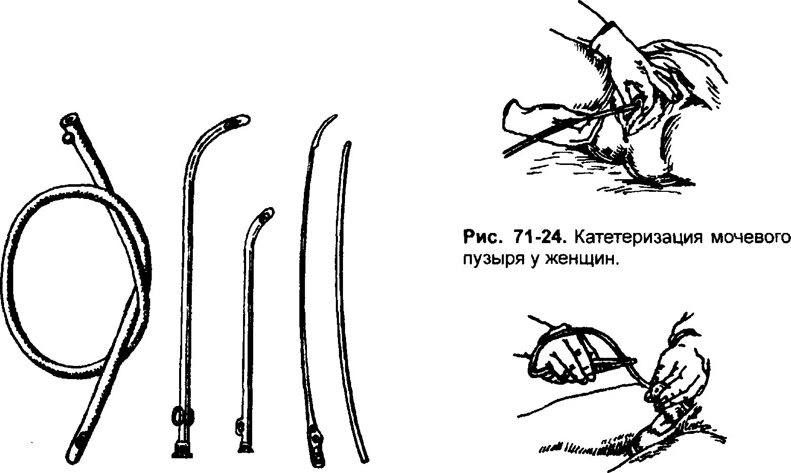 Как убрать катетер. Катетер мочевого пузыря алгоритм. Катетеризация мочевого пузыря мягким катетером. Катетеризация мочевого пузыря металлическим алгоритм. Катетеризация мочевого пузыря у женщин схема.