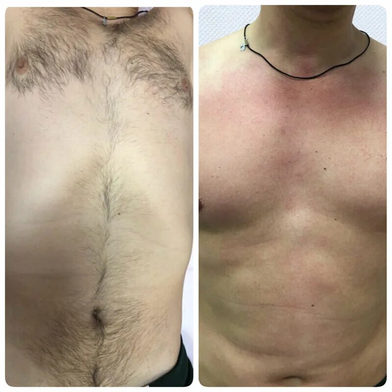 мужские интимные стрижки. шугаринг глубокое бикини. лазерная эпиляция. лазерная эпиляция. удалить волосы паху.