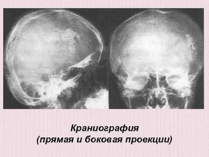 Гематомы черепа