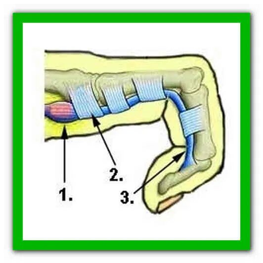 Кольцевой палец. Стенозирующий лигаментит сухожилий. Лигаментит сгибателя большого пальца. Лигаментит сухожилия сгибателя. Кольцевидная связка 1 пальца кисти.