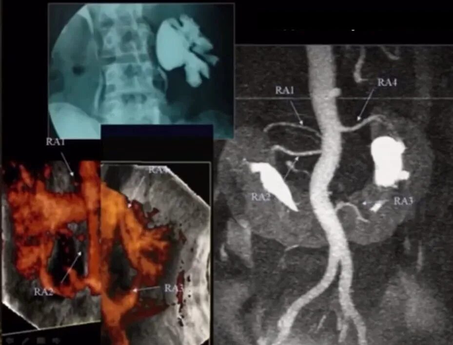 Аномалии почечных артерий. Устья почечных артерий. УЗИ почечных артерий. Подковообразная почка на УЗИ. Узи почка не видна