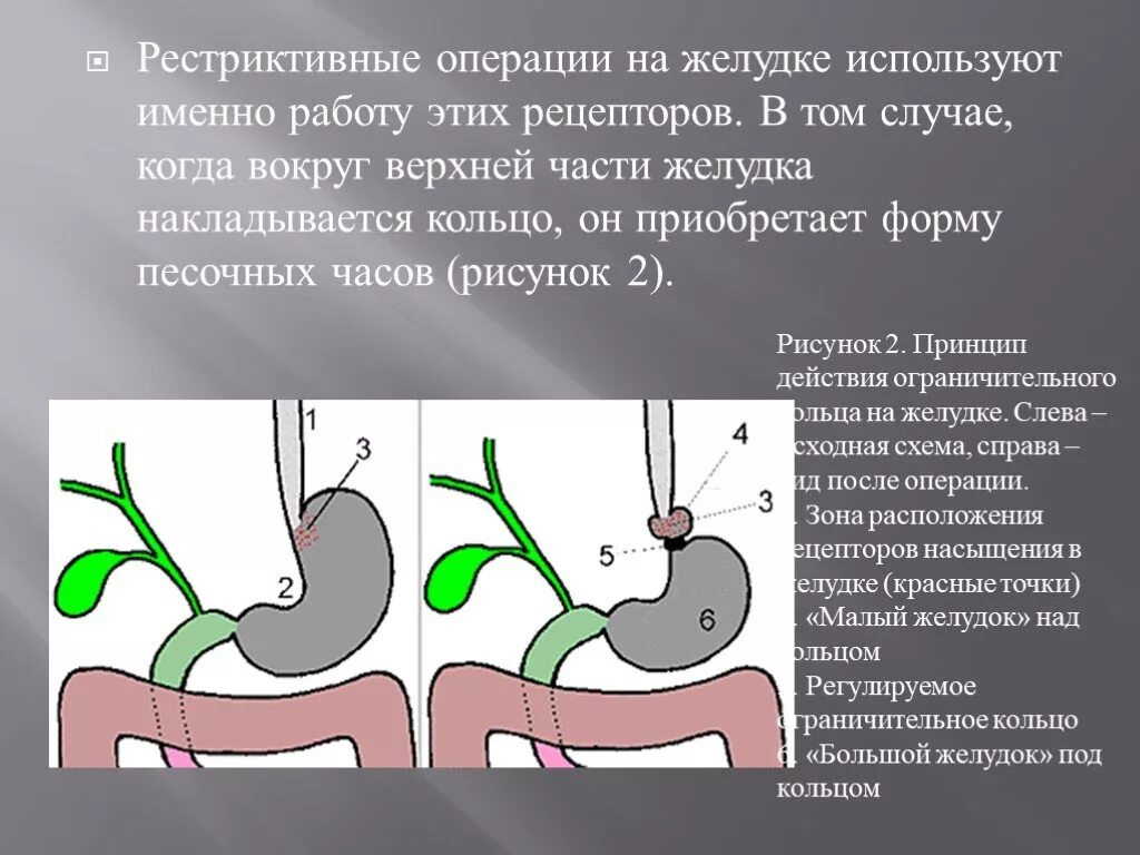 После удаления части желудка. Резекция желудка операция. Основные операции на желудке.