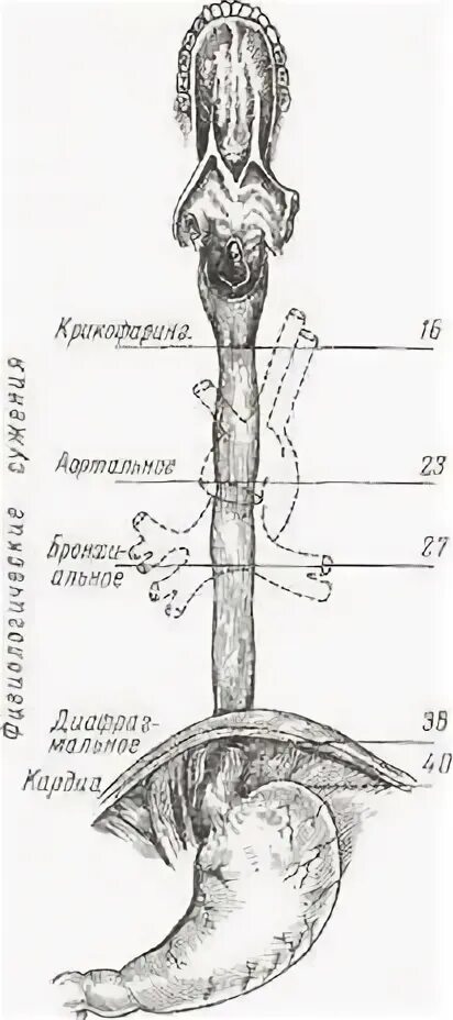 Сужения пищевода на латинском языке.