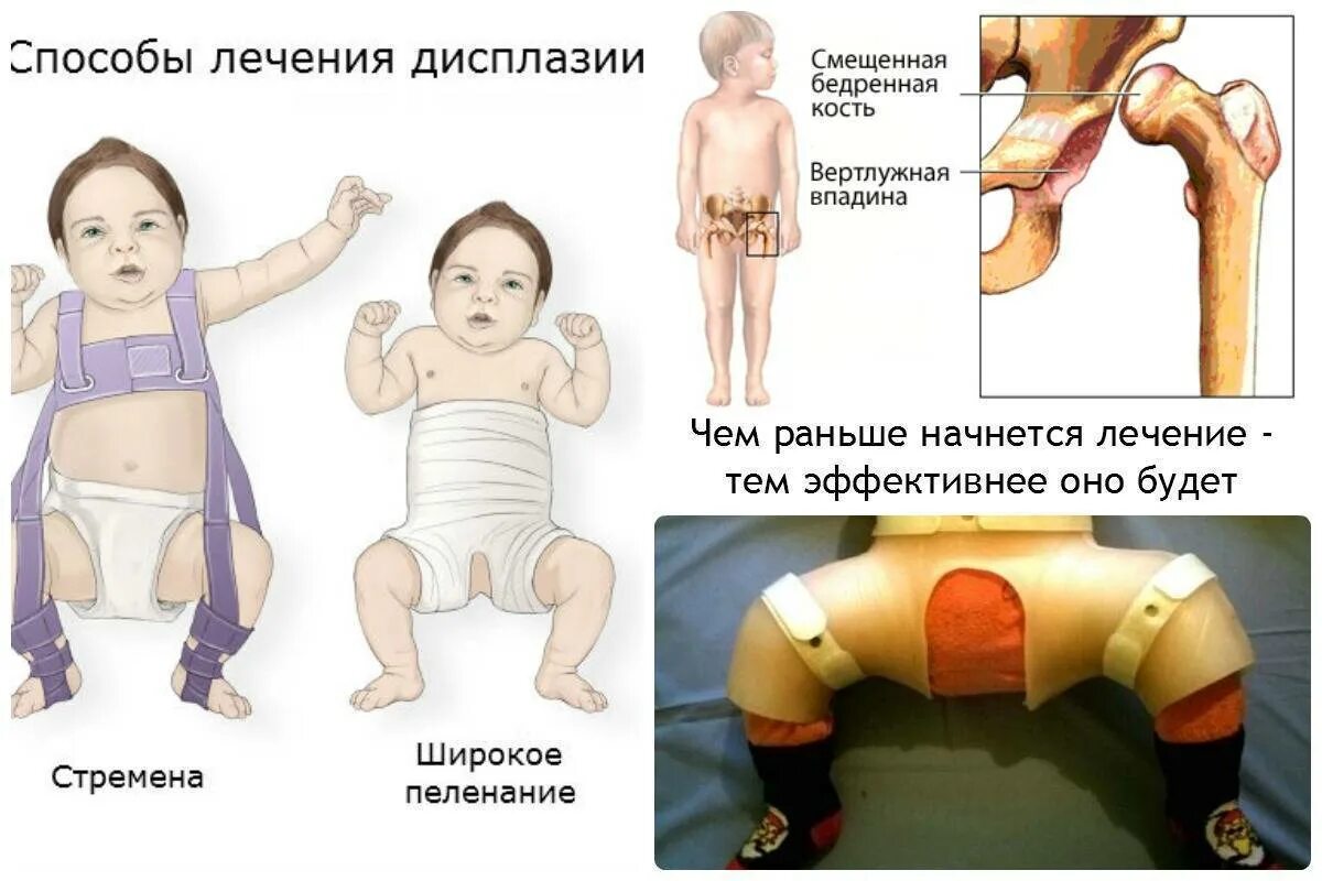 Мкб дисплазия тазобедренных суставов детей. Дисплазия тазобедренных суставов у новорожденных 1б. врождённый вывих бедра дисплазия.