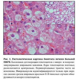 Дистрофия печени у беременных