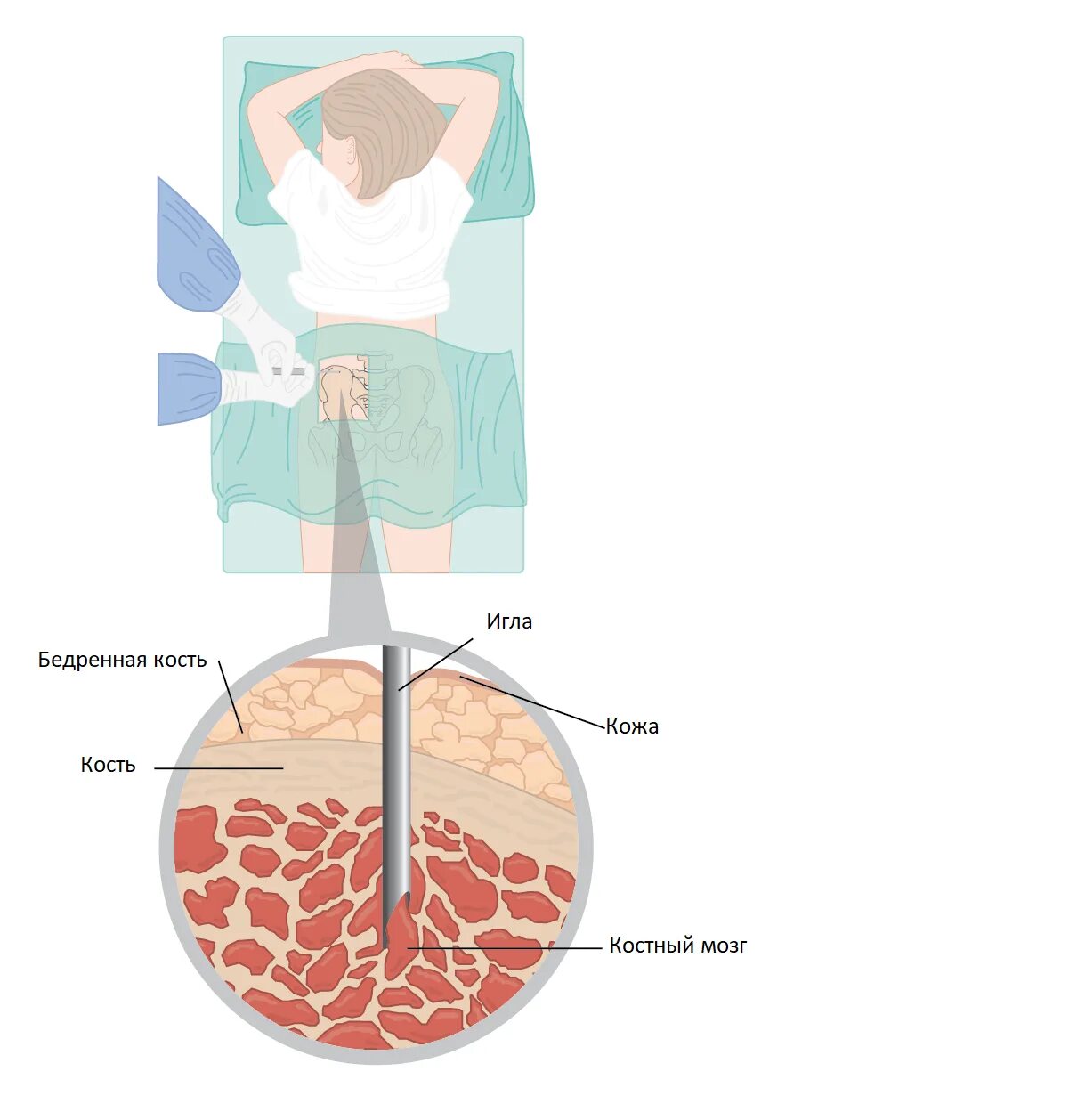 Трепанобиопсия костного мозга морфология. Аспирация костного мозга. Аспирационная биопсия костного мозга. Стернальная пункция костного мозга. Что будет если есть костный мозг