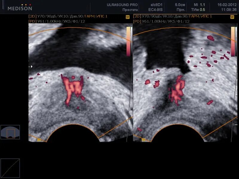 Участки фиброза в простате на УЗИ. Фиброз в предстательной железе УЗИ. Фиброз предстательной железы на УЗИ.