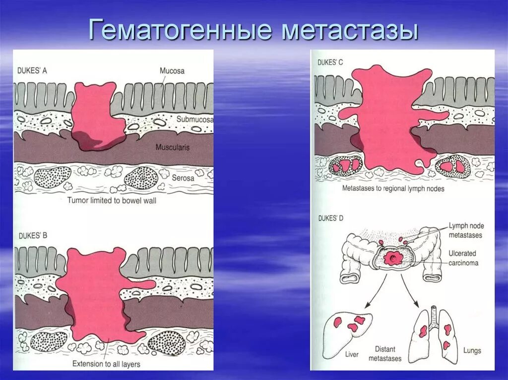 Гематогенное метастазирование. Гематогенное метастазирование опухоли. гематогенный путь метастазирования опухоли. гематогенное метастазирование схема.