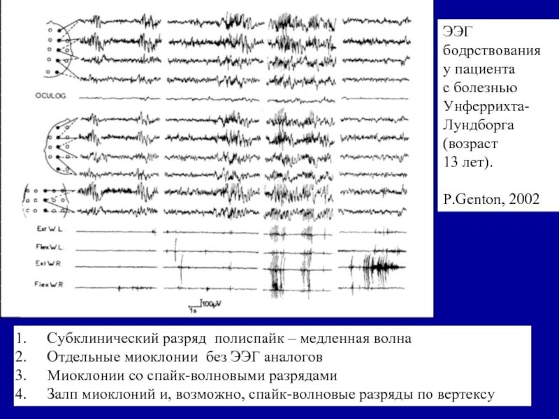 Генерализованные Спайк волновые разряды на ЭЭГ. ЭЭГ полиспайки разряд. Спайк волны на ЭЭГ при миоклонии. Медленные волны на ээг