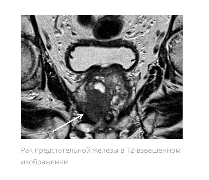 Тазовый простатит. Мультипараметрическое мрт предстательной железы. Мрт предстательной железы норма. Мрт предстательной железы мрт. Карцинома мрт предстательной железы.