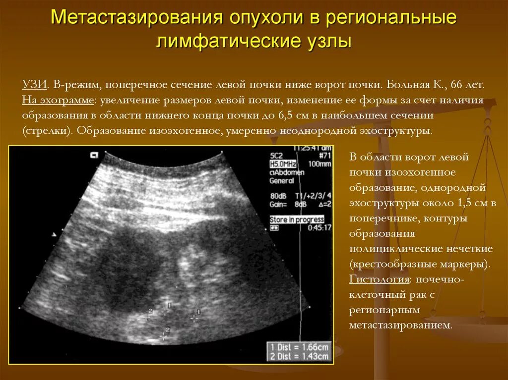 Узи брюшной полости ля фам. Региональные лимфатические узлы УЗИ. Мезентериальные лимфатические узлы в брюшной полости УЗИ. Забрюшинные лимфатические узлы на УЗИ. УЗИ лимфатических узлов брюшной полости.