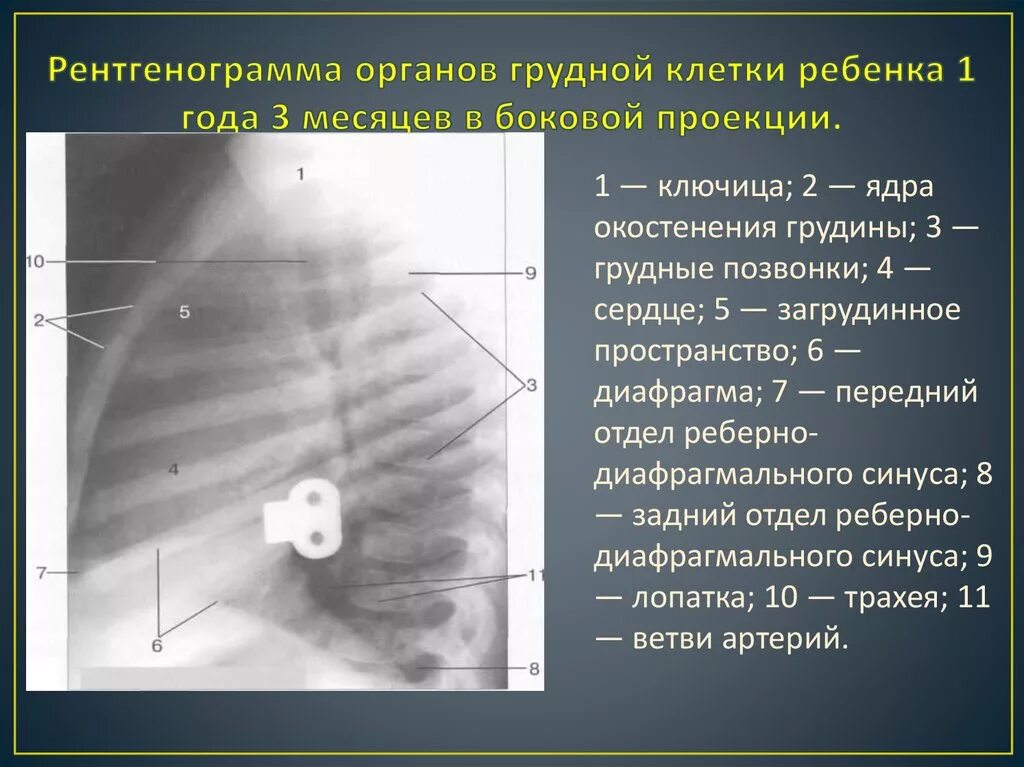 Грудная клетка у ребенка норма. Боковая проекция легких на рентгене. Рентгенограмма органов грудной клетки. Рентгенография грудины в боковой проекции. Боковая рентгенограмма органов грудной клетки.