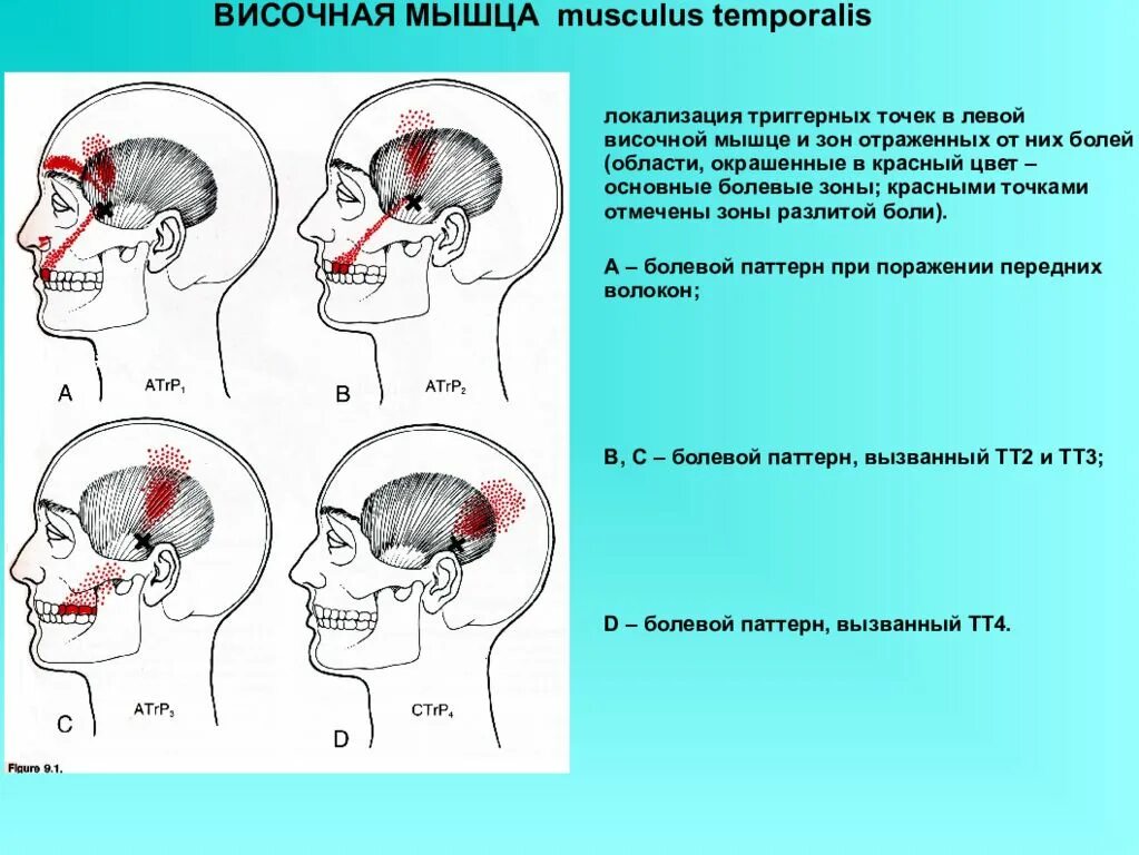 Болит голова и мышцы шеи. Дисфункция ВНЧС триггерные точки. Мышцы шеи триггерные точки схема. Триггеры височной мышцы. Височная мышца головы.