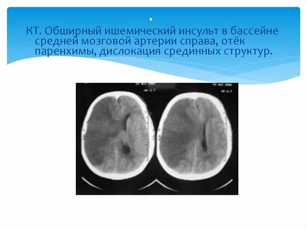 Инсульт в бассейне мозговой артерии. Ишемический инсульт кт. Ишемический инсульт в бассейне средней мозговой. Инсульт средней мозговой артерии. Обширный ишемический инсульт кт.