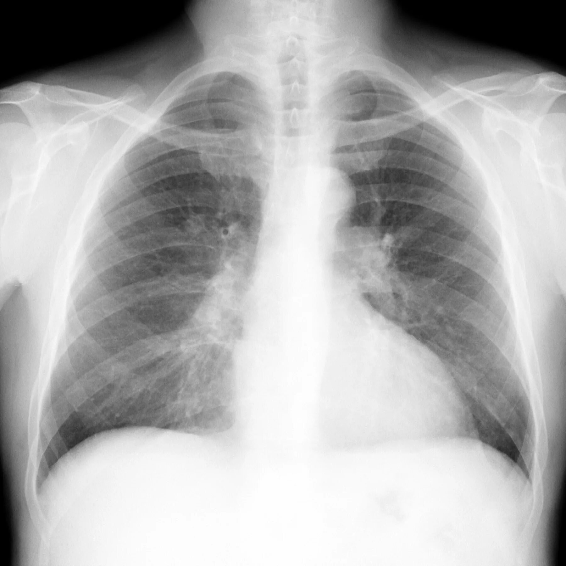 Снимок лёгких. Нормальный рентген легких. Рентген легких норма. Флюорография. Какие легкие в норме