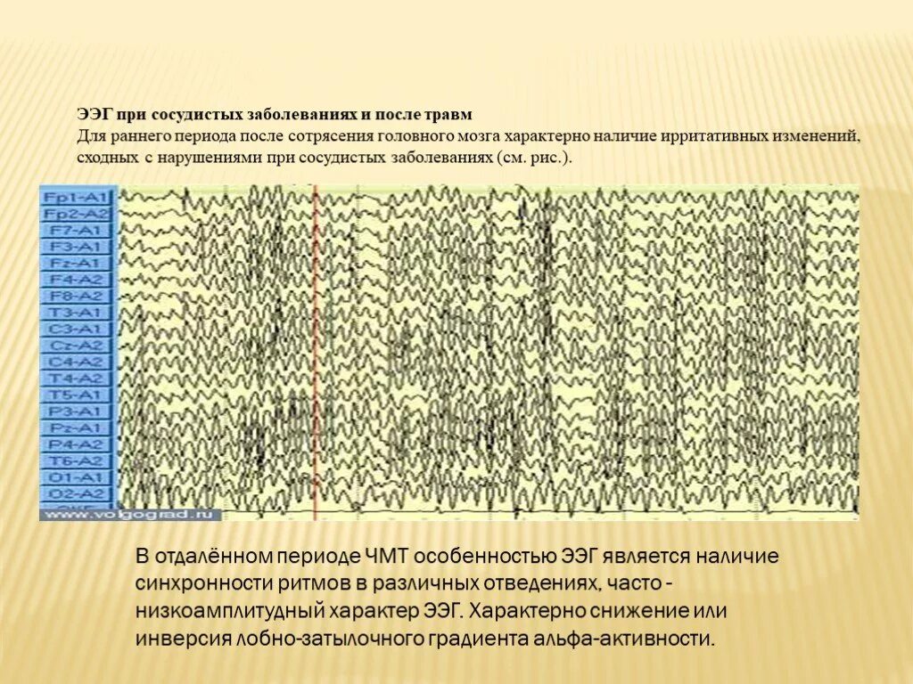 Ээг отзывы детям. ЭЭГ при патологии. Изменения на ЭЭГ. ЭЭГ при сосудистых заболеваниях и после. ЭЭГ при сосудистой патологии.