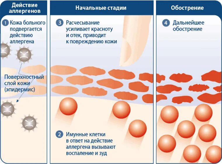 Механизм развития контактного аллергического дерматита. Атопический дерматит схема кожи. Атопический дерматит стадии. Фазы атопического дерматита.