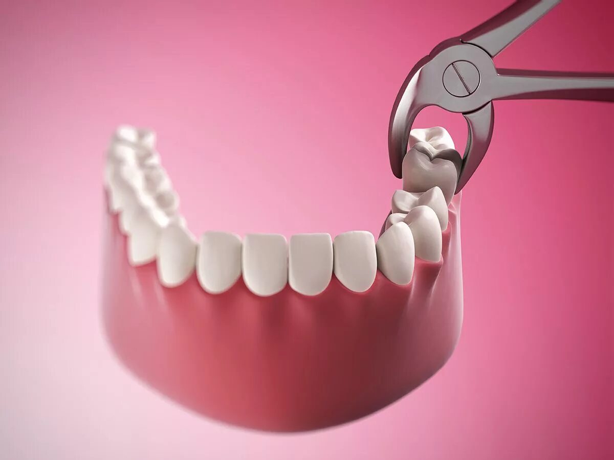 Сколько стоит снимать зуб