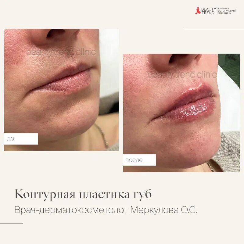 5 мл. После филлеров в губы что нельзя делать. После филлеров в губы что нельзя делать. Контурная пластика губ гиалуроновой кислотой 1 мл. После филлеров в губы что нельзя делать.