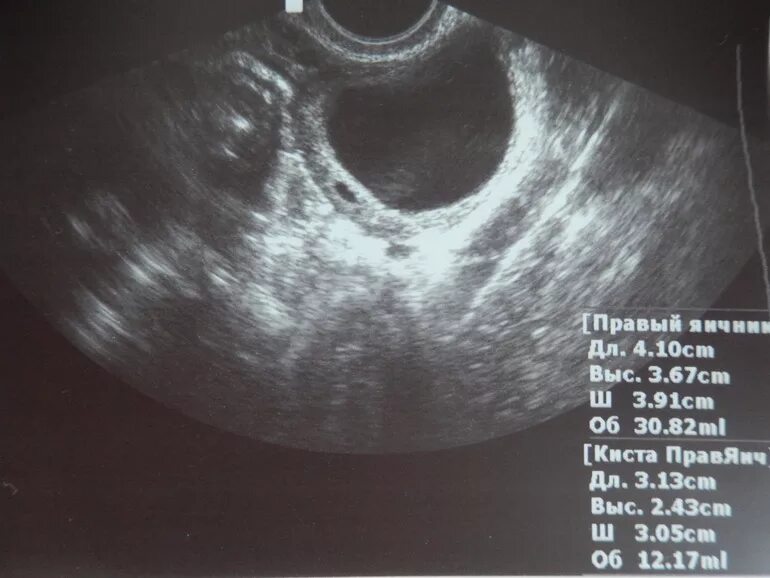 Яичник после овуляции на УЗИ. Жидкость в позадиматочном пространстве после овуляции. Жидкость в позадиматочном пространстве на УЗИ. Двухкамерная киста желтого тела. Можно перепутать беременность с кистой