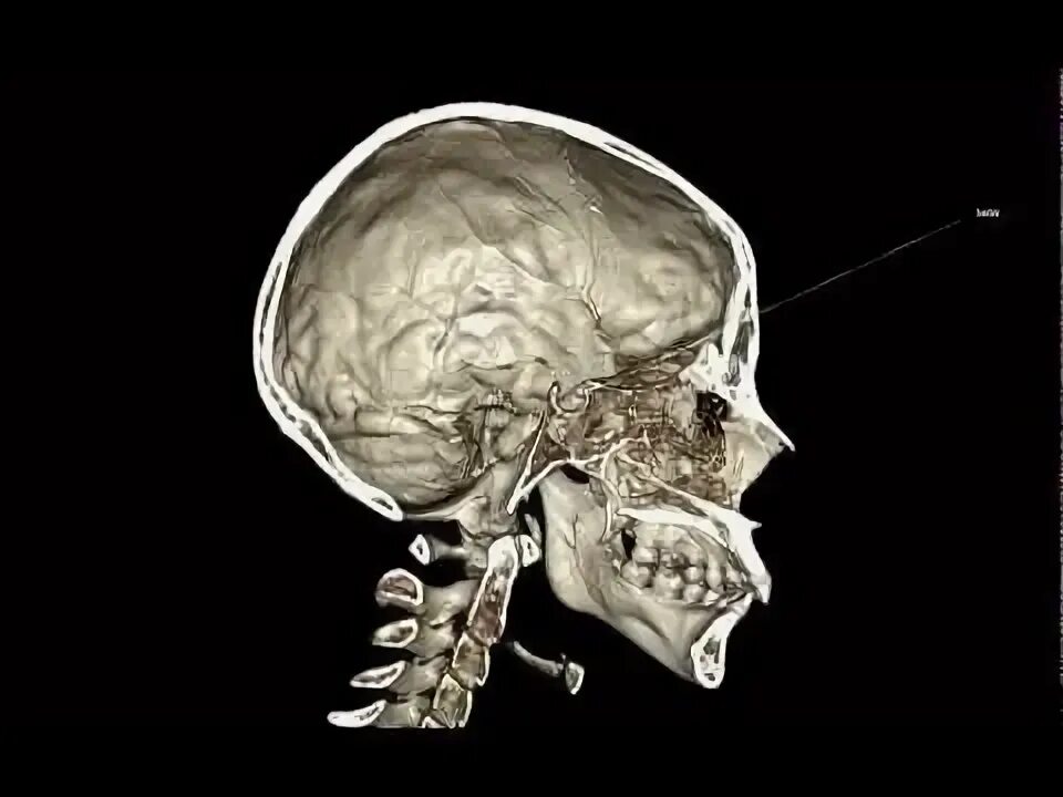 Кт костей лицевого черепа + 3 d цефалометрия. 3d цефалометрия кт. 3d цефалометрия кт. Кт костей лицевого отдела черепа 3d цефалометрия. 3d цефалометрия кт.