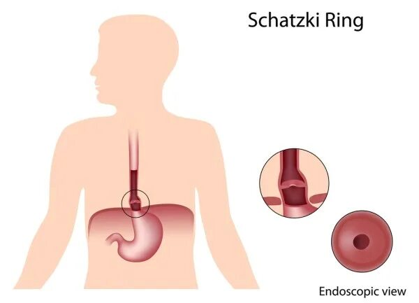 Кольцо шацкого в пищеводе. Формирующееся кольцо Шацкого. Верхнее пищеводное кольцо Шацкого.