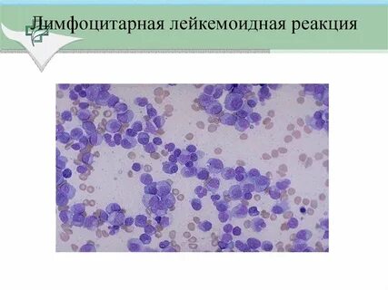 Лейкемоидная реакция