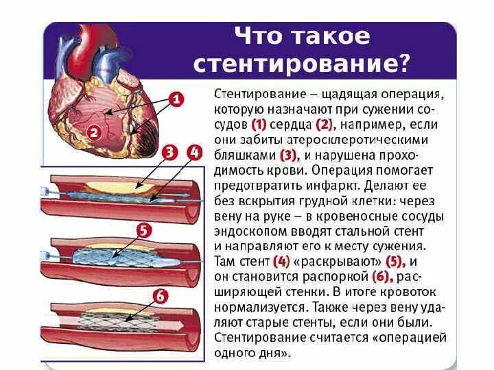 Коронарография сосудов стентирование. Стентирование коронарных артерий схема. Операция стентирование сосудов сердца. Операция коронарография сосудов сердца. Стентирование сосудов последствия