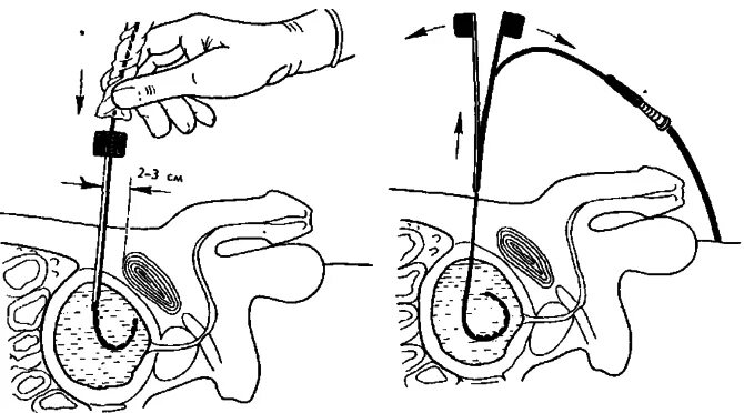 Катетер простату. Цистостома мочевого пузыря катетер. Троакарная эпицистостомия. Операция троакарная цистостомия. Пункция мочевого пузыря.