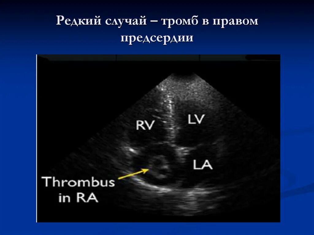 Образование левого предсердия. Тромб правого предсердия ЭХОКГ. Флотирующий тромб правого предсердия. Тромбоэмболия легочной артерии УЗИ. Тромб в правом предсердии кт.
