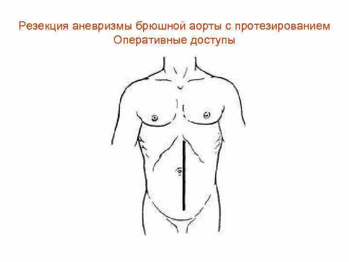 Пульсация аорты. Пальпация брюшной аорты. оперативный доступ к брюшной аорте. левосторонняя торакофренолюмботомия. торакофренолюмботомия разрез.